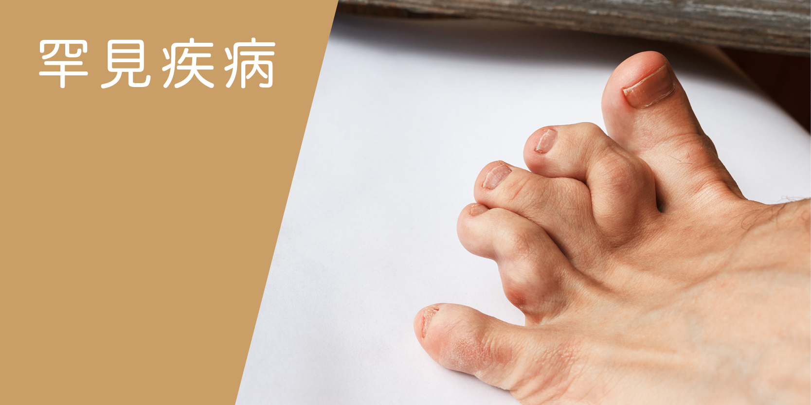 罕見疾病