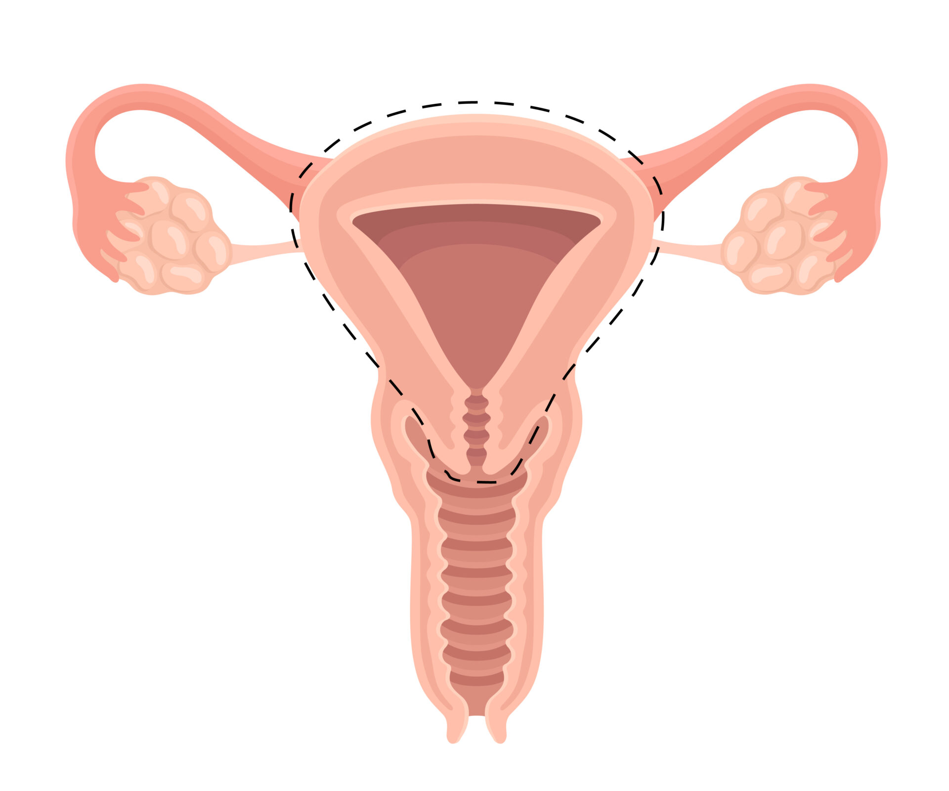 卵巢癌-子宮全切除術