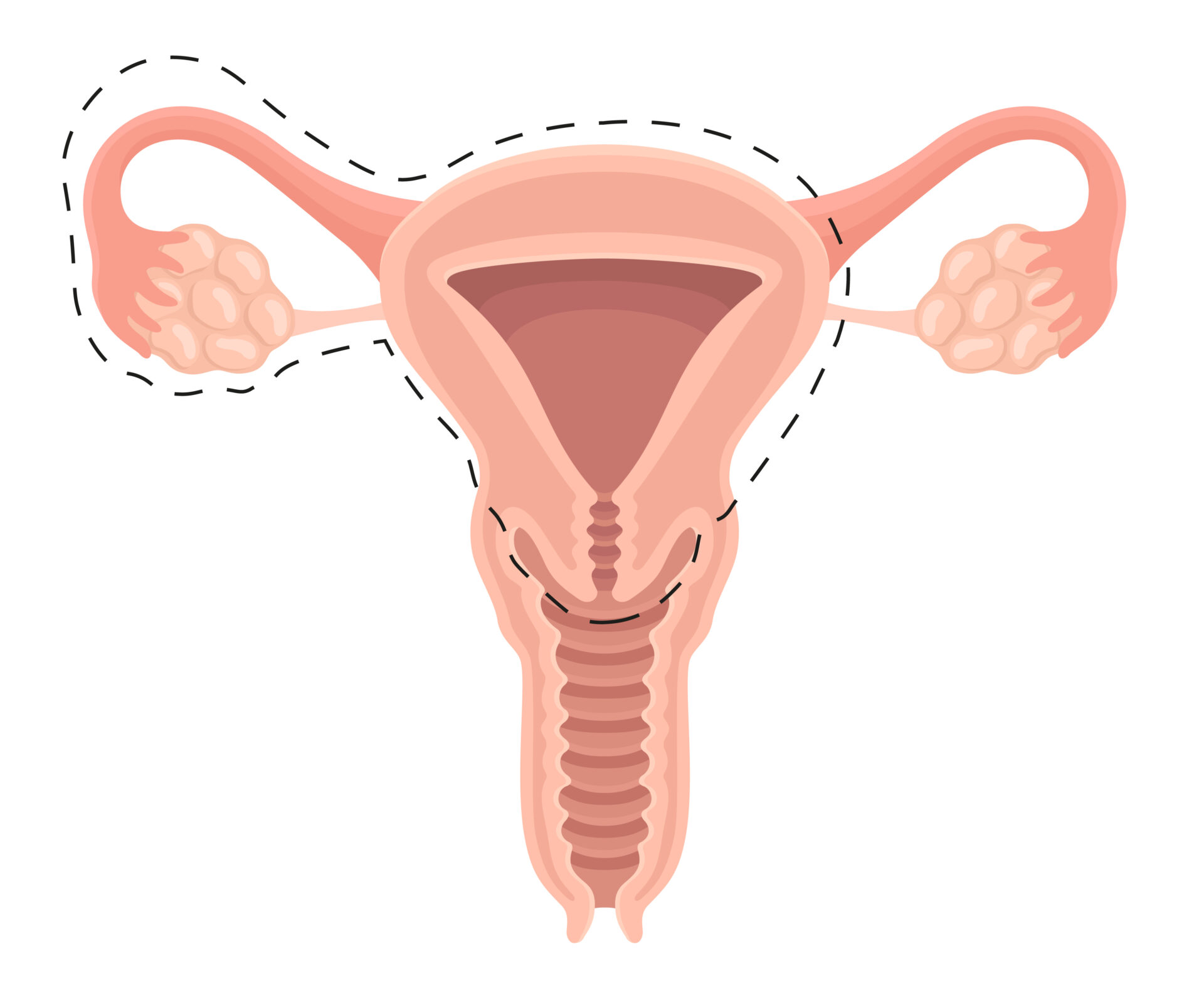 卵巢癌-輸卵管及卵巢及子宮全切除術
