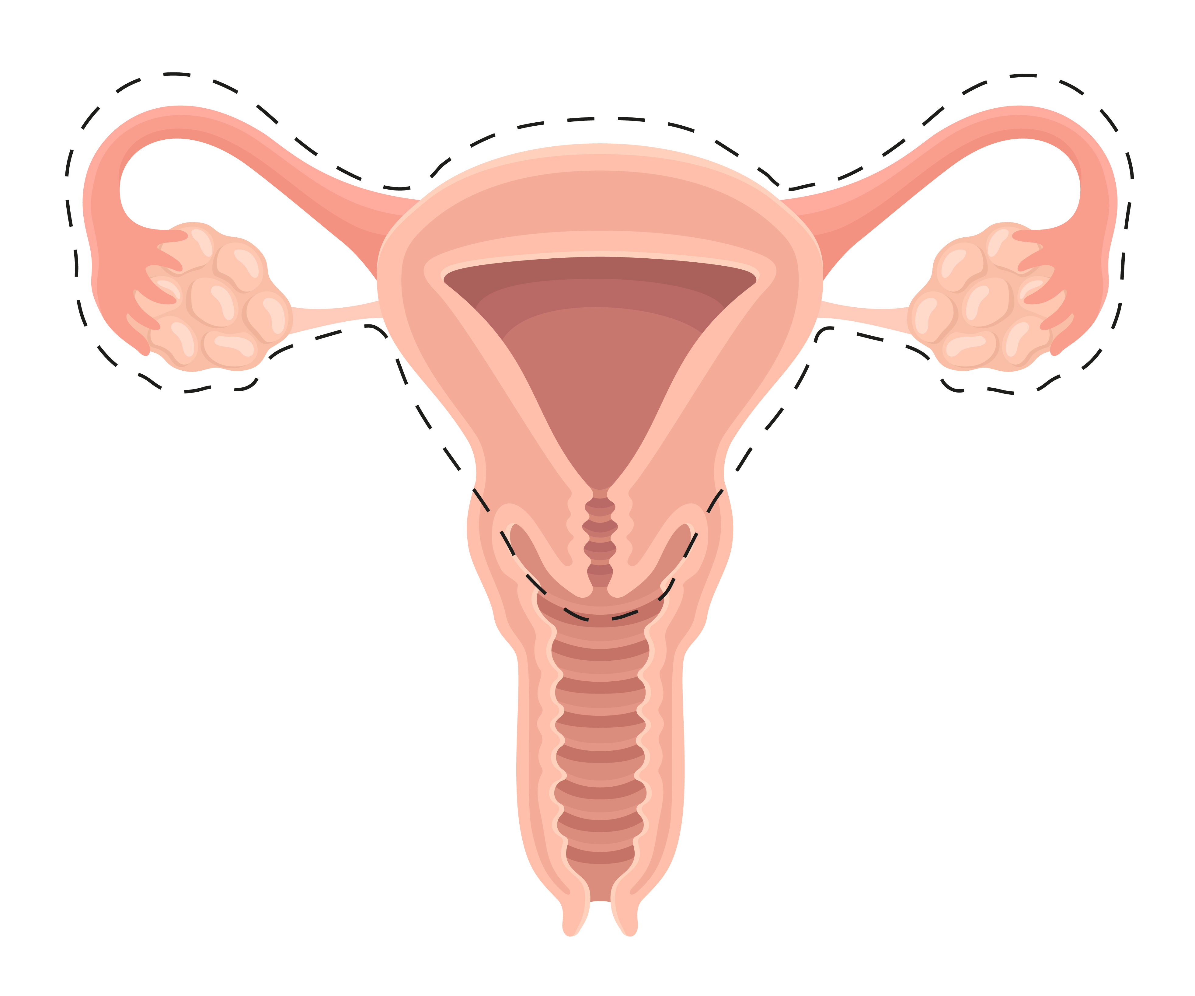 卵巢癌-輸卵管及卵巢及子宮全切除術