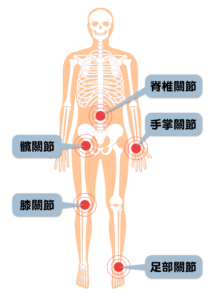 骨關節炎最常涉及的部位
